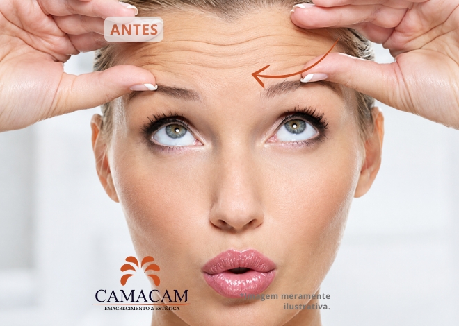 Toxina botulínica (Botox) - Antes