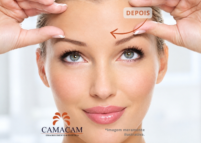 Toxina botulínica (Botox) - Depois
