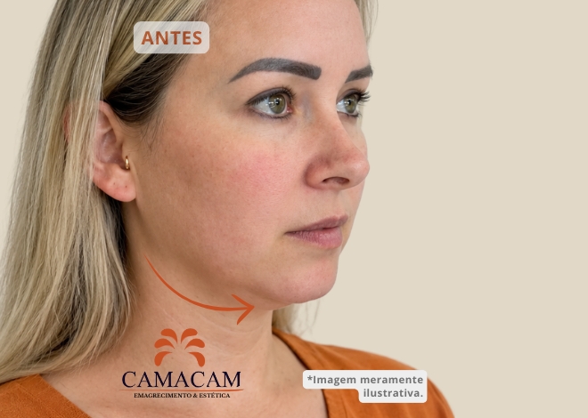 Preenchimento facial com ácido hialurônico - Antes