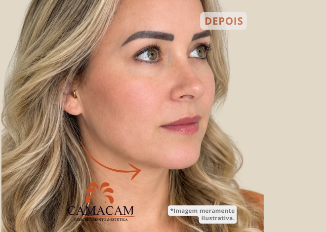 Preenchimento facial com ácido hialurônico - Depois