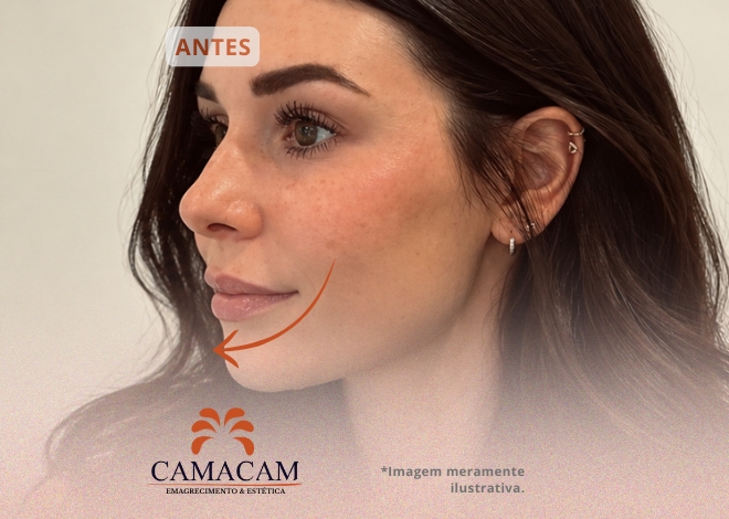 Preenchimento labial - Antes