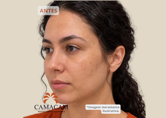 Skinbooster - Antes