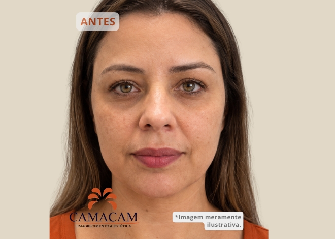 Intradermoterapia facial - Antes
