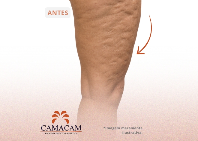 Injetáveis intramuscular para emagrecimento - Antes
