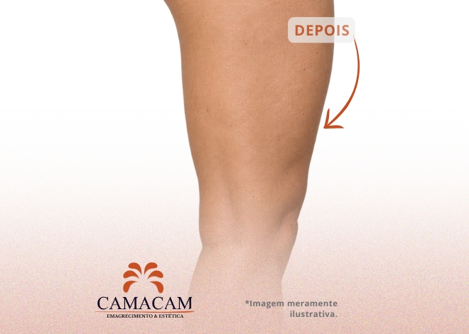Injetáveis intramuscular para emagrecimento - Depois