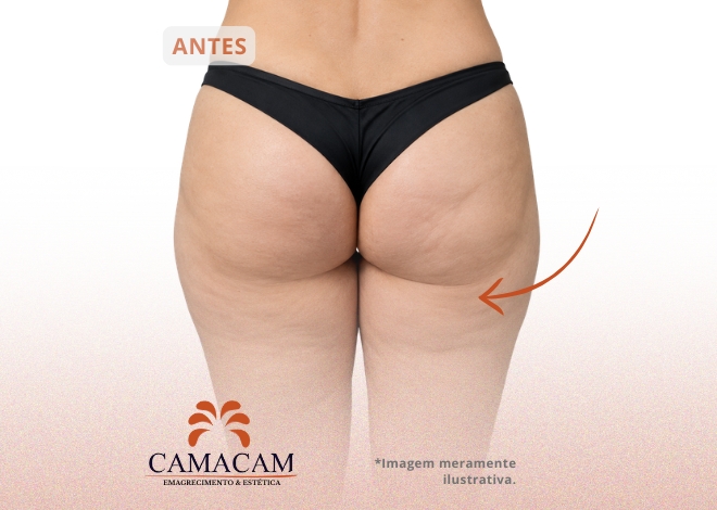 Tratamentos injetáveis para celulite - Antes