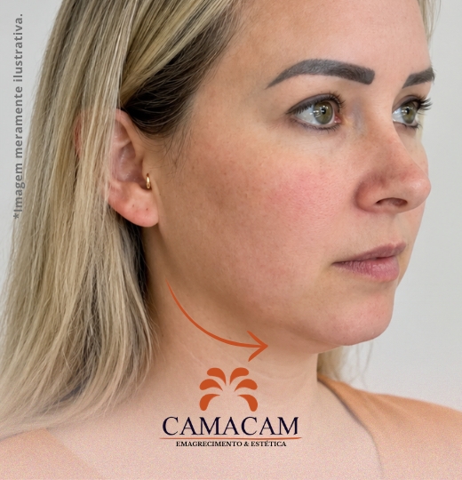 Preenchimento facial com ácido hialurônico | 2