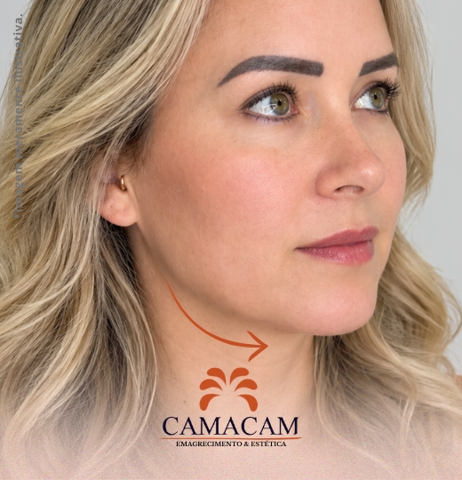 Preenchimento facial com ácido hialurônico | 3