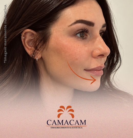 Preenchimento labial | 2