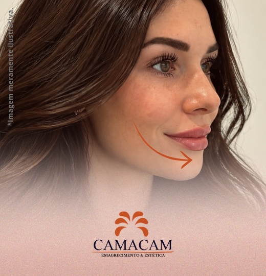 Preenchimento labial | 3