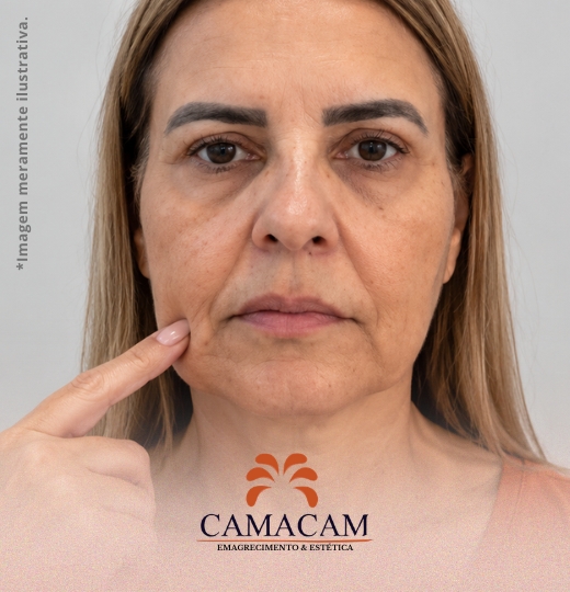 Bioestimuladores de colágeno | 2