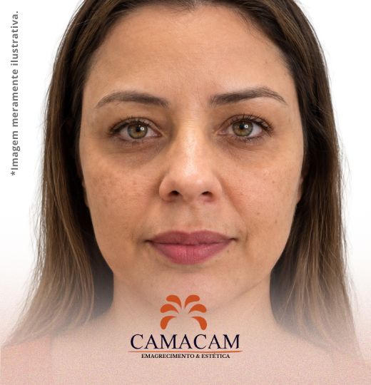 Intradermoterapia facial | 2