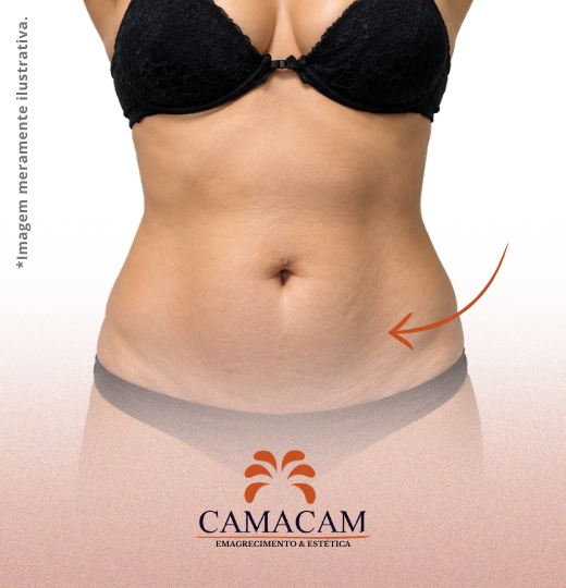 Intradermoterapia corporal | 2
