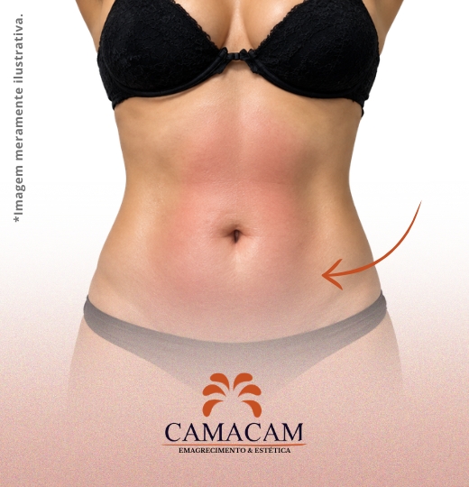 Intradermoterapia corporal | 3